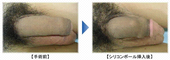 コハルちゃんが首チンコに改造されてかわいそうな目に遭う本（キノコの王様）の通販・購入はメロンブックス | メロンブックス