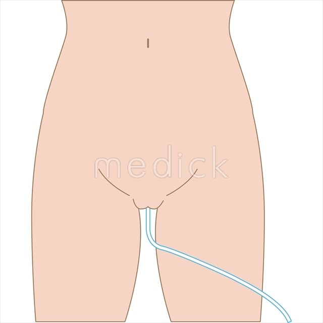 持続的導尿カテーテルの挿入(男性) | 動画でわかる看護技術