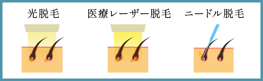 VIO脱毛後の排尿は注意！尿の飛び散りの傾向と対策 - トイトイトイクリニック