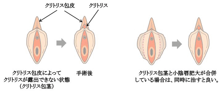 クリトリスにも勃起や包茎がある？ 仕組みやチェック方法を解説 ｜