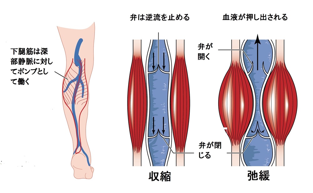 静脈瘤で起こる様々な症状について | ブログ