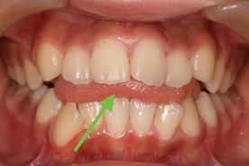 唇を噛む癖で歯並びが悪くなる？ | 横浜駅前歯科・矯正歯科