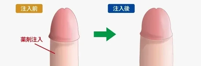 鼻が大きいとペニスも大きい」は本当だった！ – メンズ形成外科