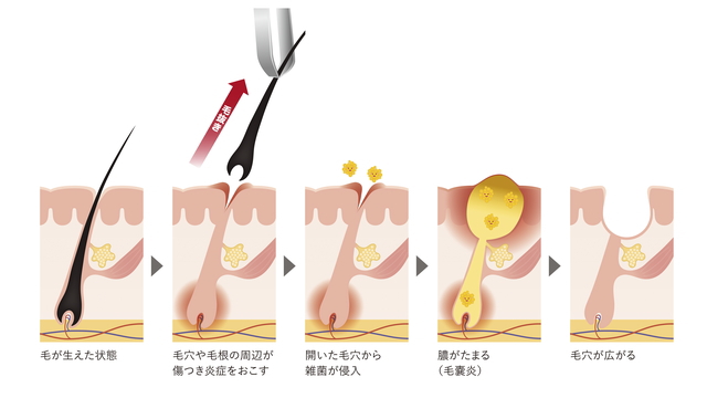 髪の毛を抜くとはげる？癖や病気で抜き続けるリスクやまた生えてくるかも解説 | 育毛のミカタ