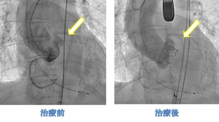 脳血管性認知症ー予防と治療ー | 脳疾患を知る |