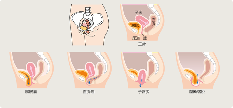 膀胱脱（膀胱瘤）｜すこやかコラム｜ときわ会グループ