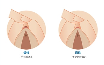 クリトリス包茎の治療のご案内｜婦人科形成の帯広中央クリニック