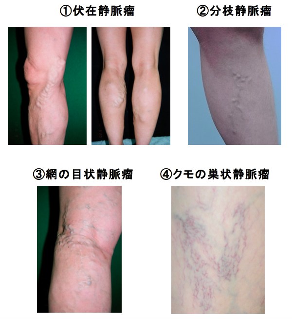 下肢静脈瘤の症状 - 医療法人社団康静会