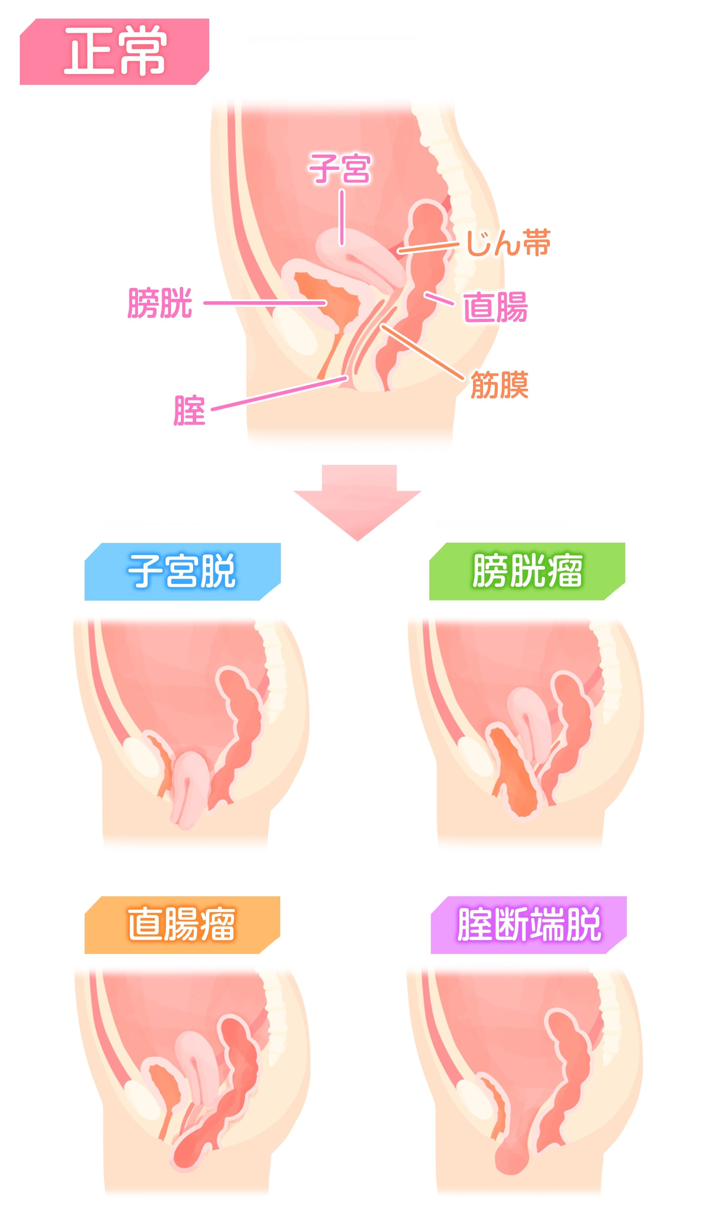 正しい排尿方法を知って黒ずみを予防しよう | VIO脱毛サロンRUCIA 脱毛専門家の渋井綾乃