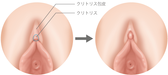 クリトリス包茎術 | 美容皮膚科サクラアズクリニック｜大阪心斎橋・福岡天神