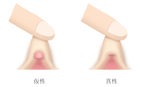 クリトリス包茎 | ゆかりレディースクリニック