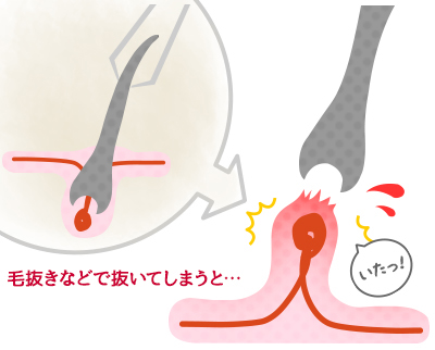 毛抜きで脱毛はNG！肌に負担をかけない＆医療脱毛に影響が出ないムダ毛の自己処理方法とは - 【東京4院・大阪3院】美容皮膚科フェミークリニック