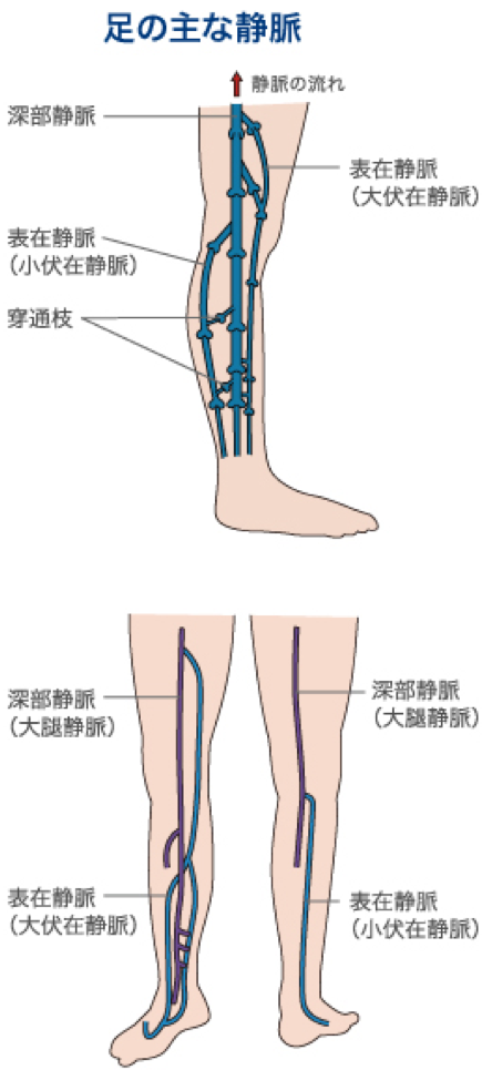 下肢静脈瘤とは｜ドクターが推薦する専門医療機関