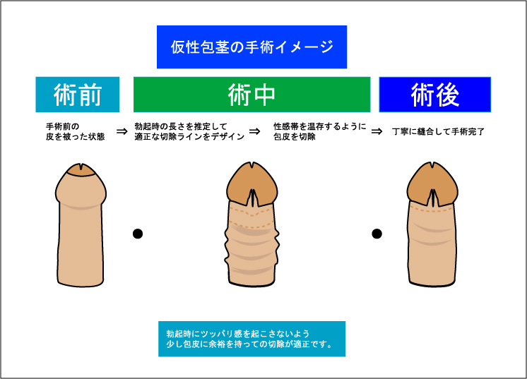 仮性包茎と真性包茎のコンドームの付け方！【医師監修】 - 夜の保健室