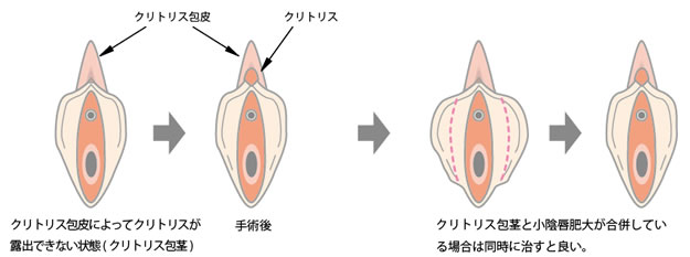 小陰部の大きさの標準は？チェックの方法と悪化させないセルフケア｜【京都】いとうらんクリニック四条烏丸