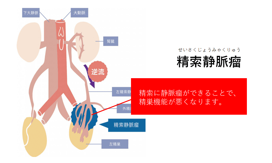 尿路結石の発作（痛み）について | こだいら泌尿器科