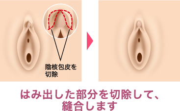 小陰唇縮小手術や副皮切除や陰核包皮切除術（クリトリス包茎）などの婦人科形成｜静岡の美容皮膚科・美容外科ならスキンクリニック藤枝院/掛川院【公式】