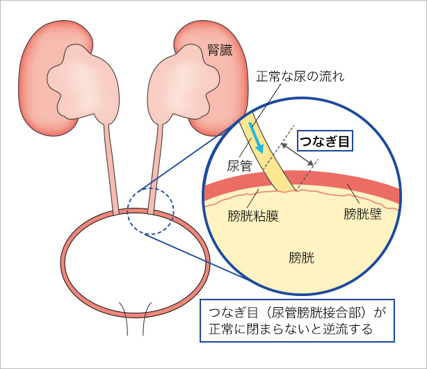 膀胱炎とは｜なりた泌尿器科・内科クリニック｜千葉県流山市の専門医