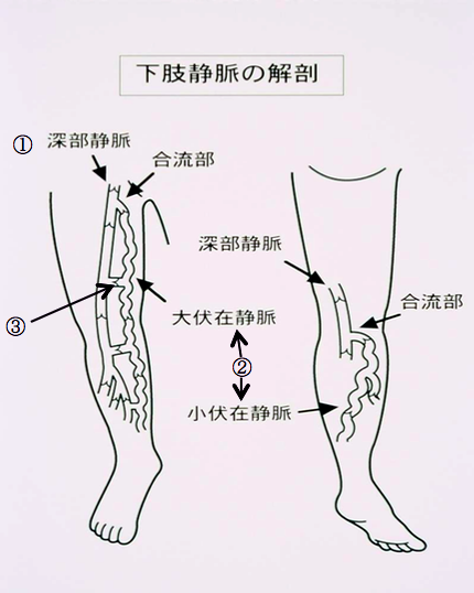 ふくらはぎがだるい｜下肢静脈瘤の日帰り手術