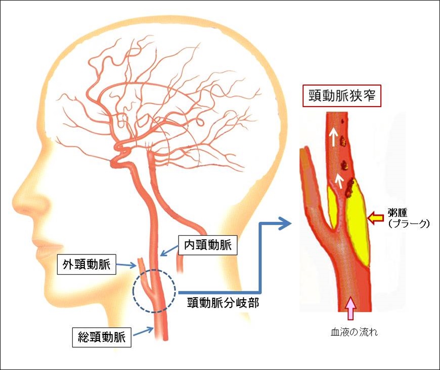 確かに血圧は下がるけれど、安易に押すと危険なツボ 本当にオススメなのは | 楽しく下げる高血圧