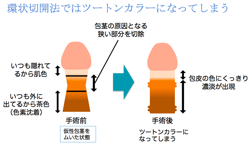 2点セット フォースキンリング Snailage Geometric