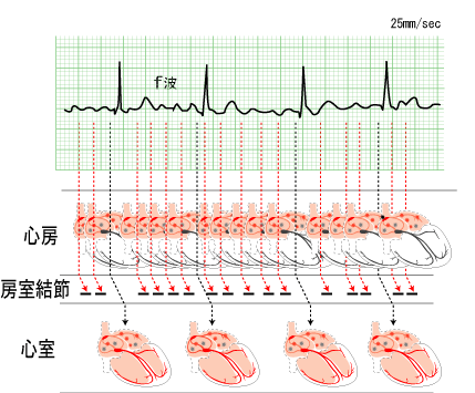 心房細動（Af）｜P波が見つからない心電図(2) | 看護roo![カンゴルー]