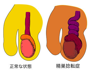 精索捻転】下腹部が痛い・・・それって精巣は大丈夫？【超音波】 | 茨城県立こども病院 専攻医募集サイト