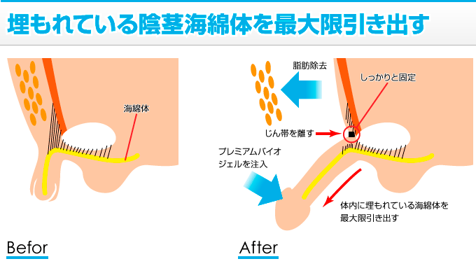 短小包茎とは！短小は何センチから？日本人の平均サイズや治療法 - アトムクリニック -