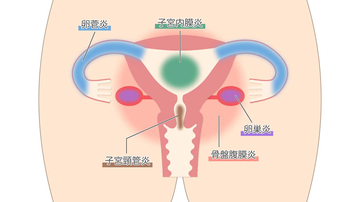 腟に何か挟まっている？尿が出にくい！フェムゾーンの違和感の謎‐ILACY(アイラシイ)働く女性の医療メディア