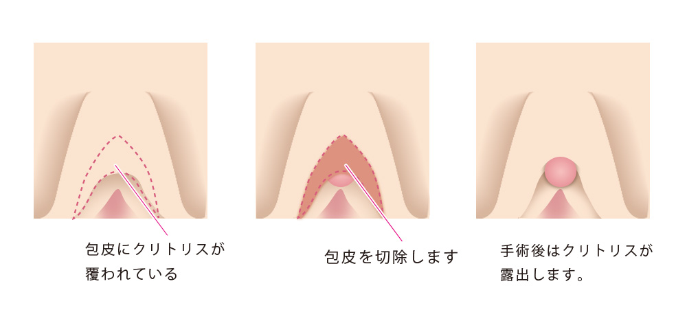 FAQ: ホルモン投与期間が長いほど、クリトリスの肥大化は見込まれますか？ - タイSRS