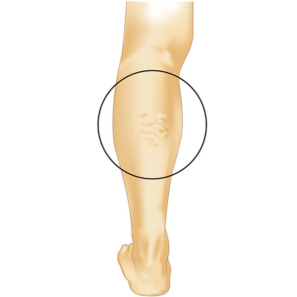 下肢静脈瘤とはどんな病気？ - こうち静脈ケアクリニック：下肢静脈瘤レーザー治療
