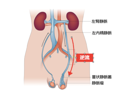 精索静脈瘤（せいさくじょうみゃくりゅう）とは｜泌尿器と男性不妊のクリニック｜埼玉県さいたま市大宮区の泌尿器科