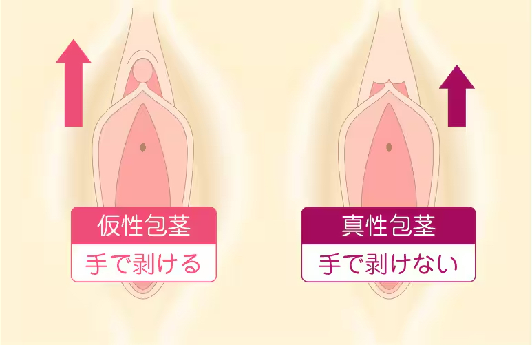 皮かむり (かわかむり)とは【ピクシブ百科事典】