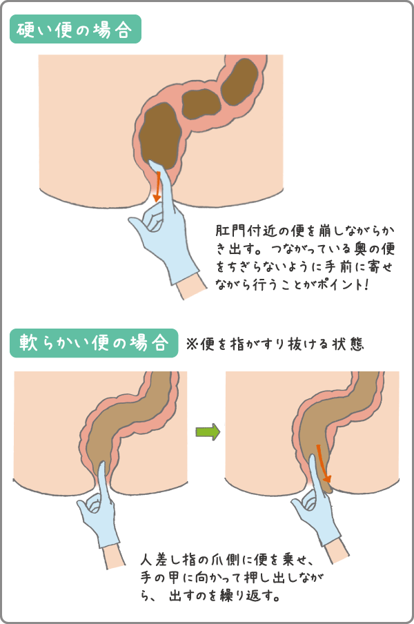 tips]アナル奴隷の作り方。浣腸排泄でM女を調教しよう | 私雨 アナル奴隷系SM調教ブログ