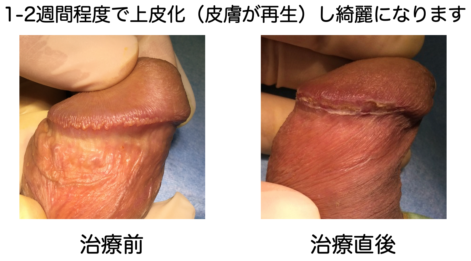 包茎患者さんに多い真珠様陰茎小丘疹（Pearly Penile Papules）: