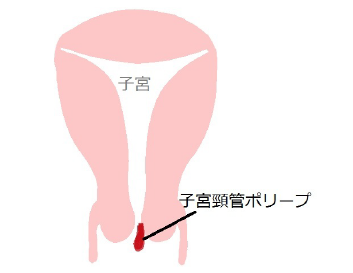 女性器ピーリング】脱毛後に気づく..膣のザラザラと黒ずみを黒ずみピーリングで一発解消！ - YouTube