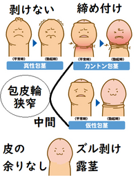 高校生の包茎とは？自然と改善？取れる選択肢と包茎の注意点のお話 - アトムクリニック - atom-clinic