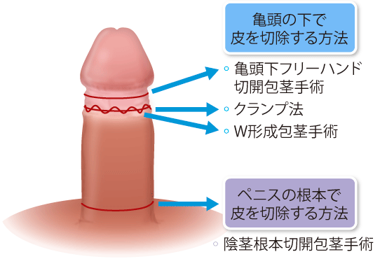 クリトリス包茎とは？あそこの臭いや不感症の原因になることも