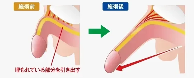 薬指が長いとペニスも長い？驚きの医学的関連性 – メンズ形成外科 |