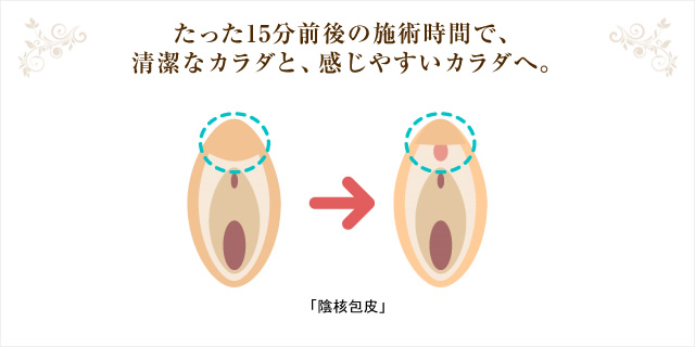 クリトリス（陰核）包茎手術 | 婦人科形成なら銀座駅徒歩0分のなおえビューティークリニック