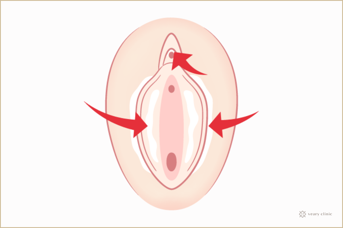 クリトリス包茎術 | 恵比寿ウエストヒルズクリニック 皮膚科・形成外科・美容皮膚科・美容外科