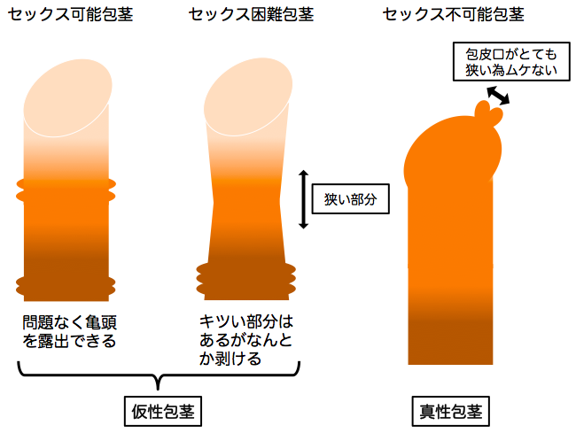 お得な イボイボ コンドーム5点＋コックリング2点 の7点セット 匿名配送