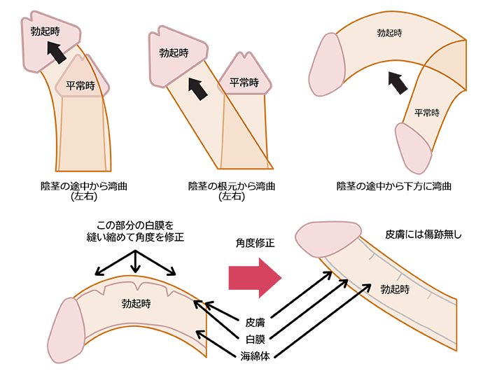 コンドームのサイズの測り方！ずれる対処法【医師監修】 - 夜の保健室