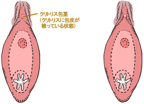 クリトリス包茎手術｜見た目・感度を改善！女性器整形「クリトリス包茎手術」の効果・経過・ダウンタイムとは｜美容整形・美容外科のTAクリニックグループ