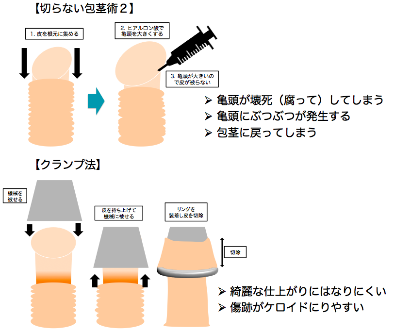 彼氏が仮性包茎です。コンドームのつけ方について調べて、正しくつけられているつもりですが、挿入して動いたりしている | Peing