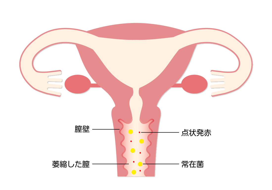 陰部のかゆみ】デリケートゾーンがかゆいのは膣カンジダ？原因をチェック｜wakanote