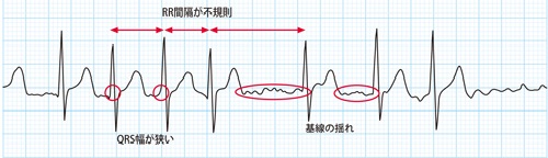 心房細動のエンジンに対するアブレーション治療は有効か？：日経メディカル